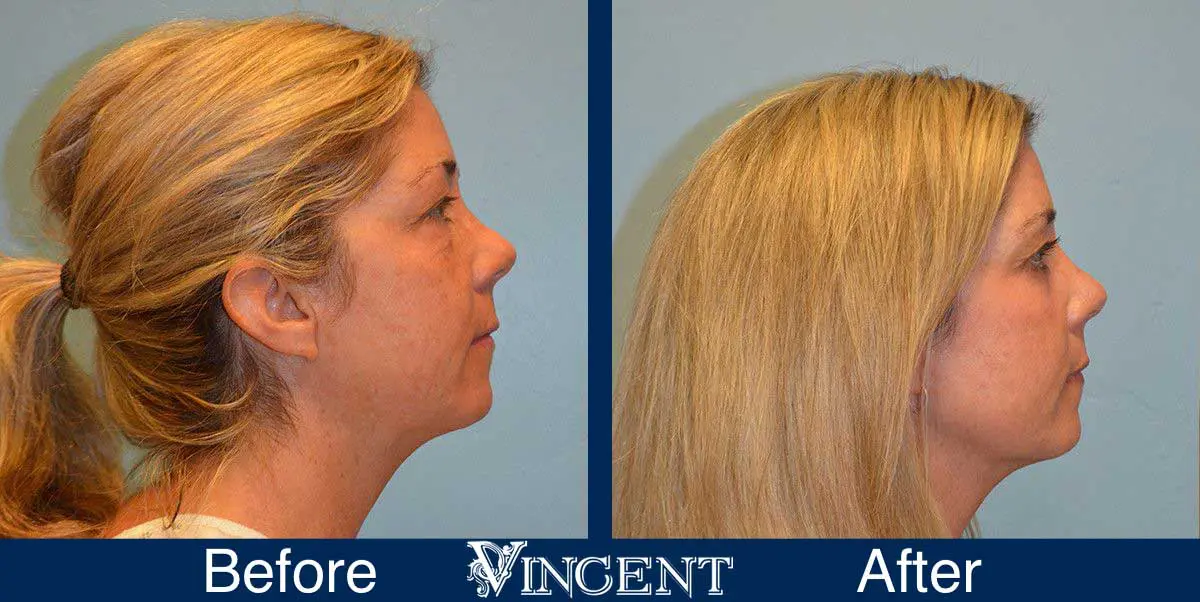 Blepharoplasty-before-and-after-utah-2605_Co2_rightside_1