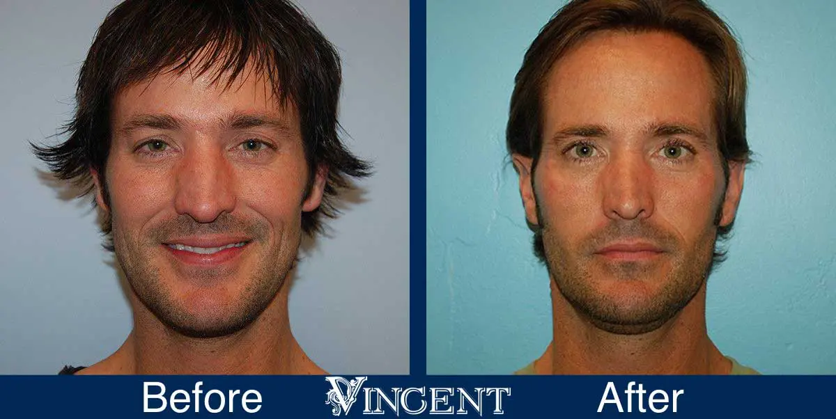 Blepharoplasty-before-and-after-utah-4503-front