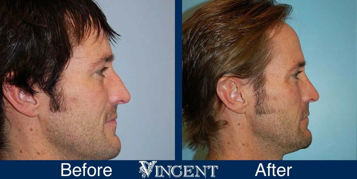 Blepharoplasty-before-and-after-utah-4503-right