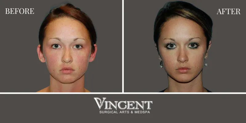 Chin Implant 2-1