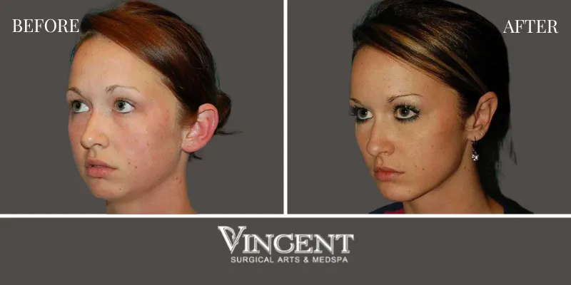 Chin Implant 2-2