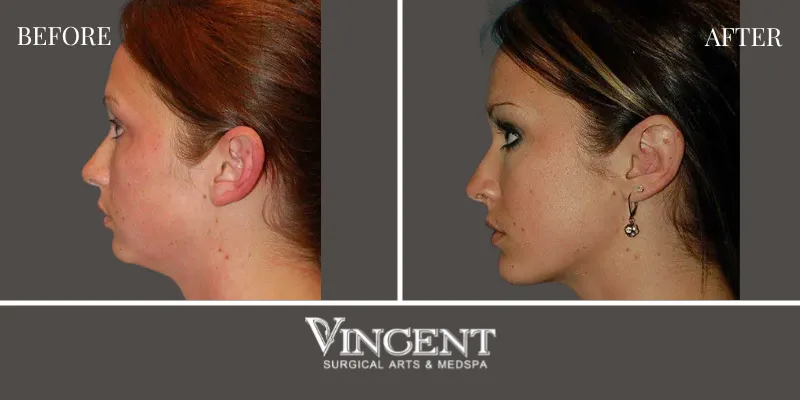 Chin Implant 2-3