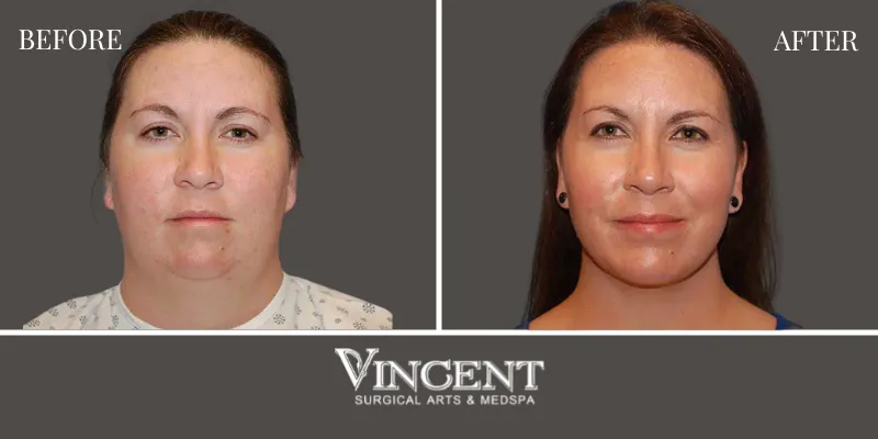 Chin Implant 3-1