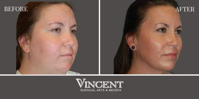 Chin Implant 3-2