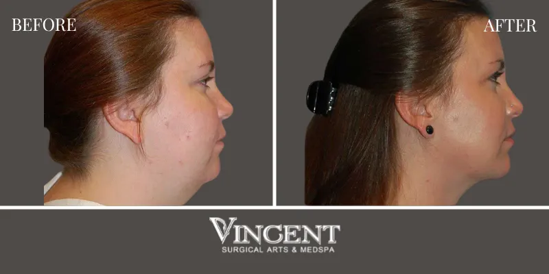 Chin Implant 3-3
