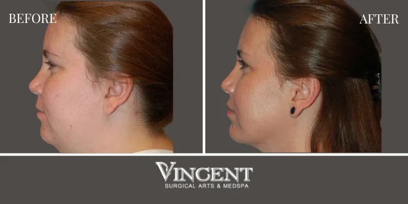 Chin Implant 3-4