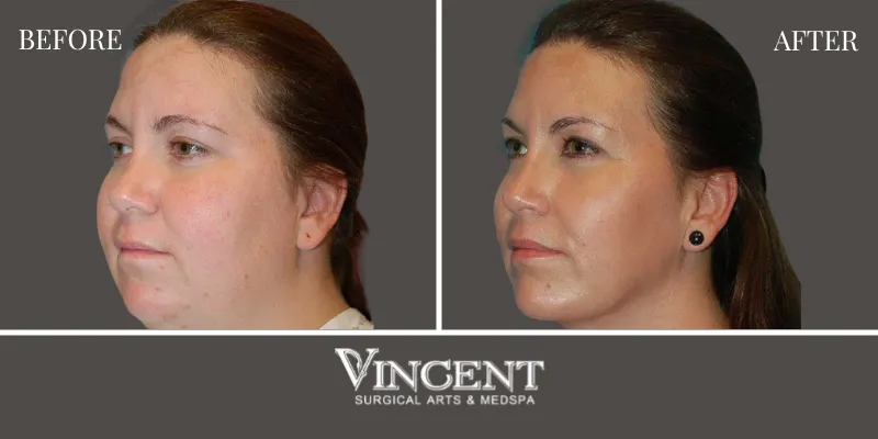 Chin Implant 3-5