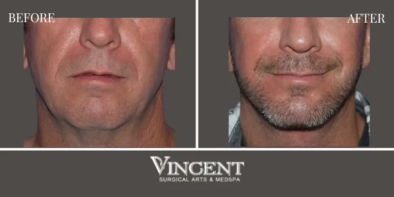 Chin Implant 4-1