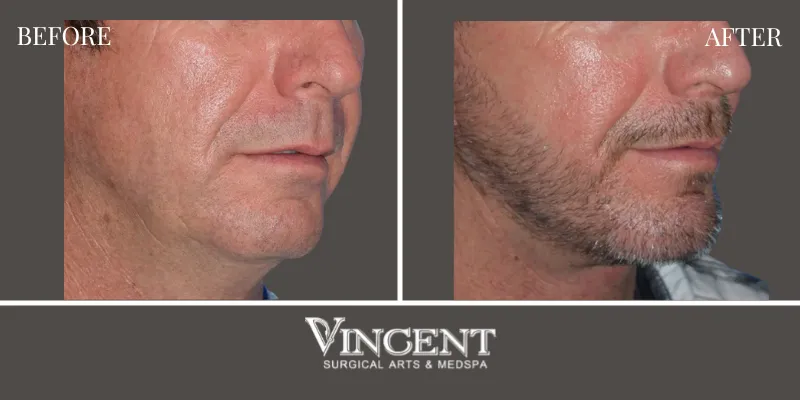 Chin Implant 4-2
