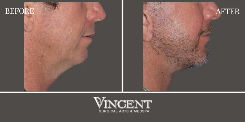 Chin Implant 4-3
