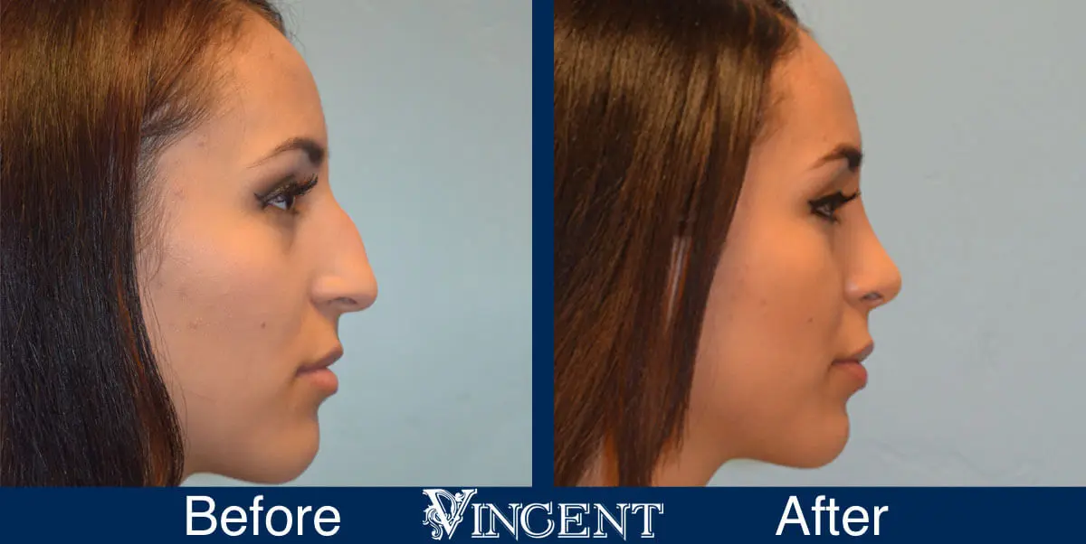 Facial-Surgery-Rhinoplasty-before-and-After-4504-1