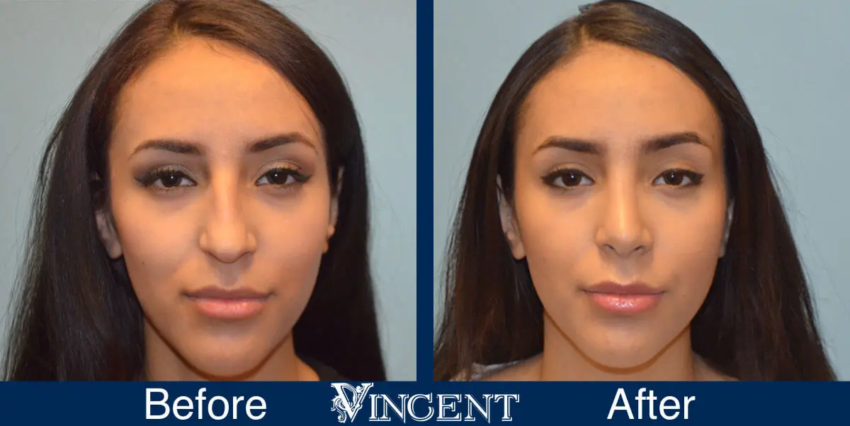 Facial-Surgery-Rhinoplasty-before-and-After-4504-2