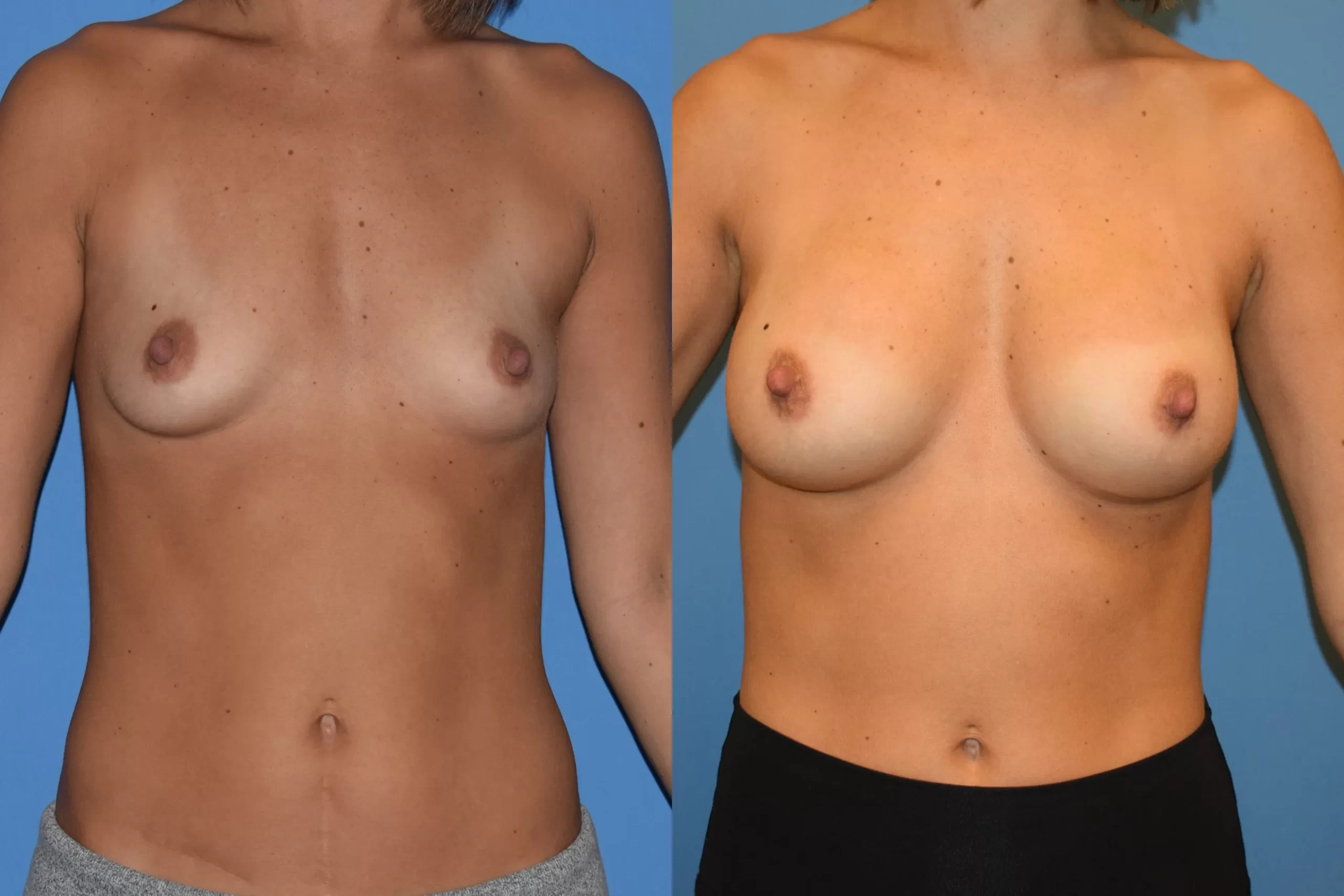 MRN-914668-Breasts-scaled_result