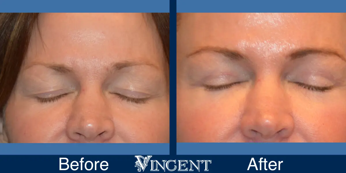 blepharoplasty-utah-A-closed