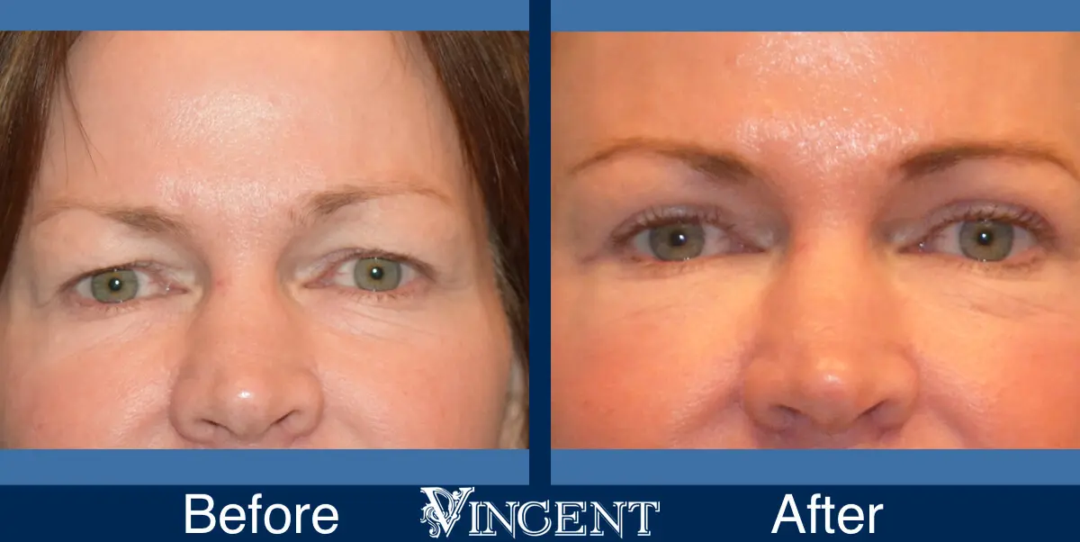 blepharoplasty-utah-A-open