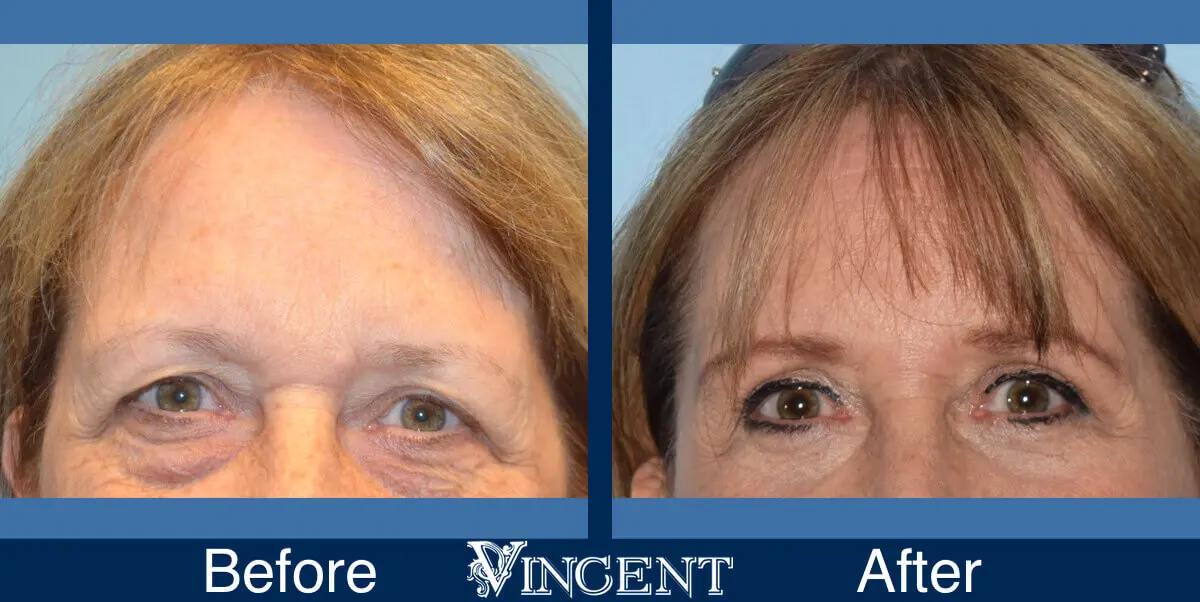blepharoplasty-utah-B-front