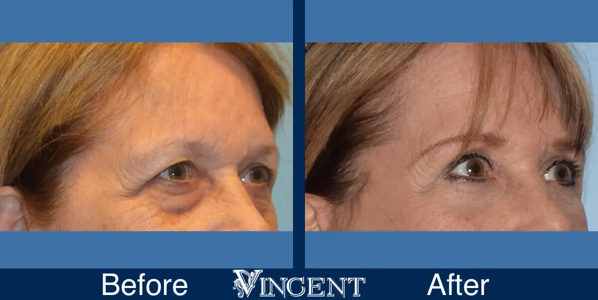 blepharoplasty-utah-B-right