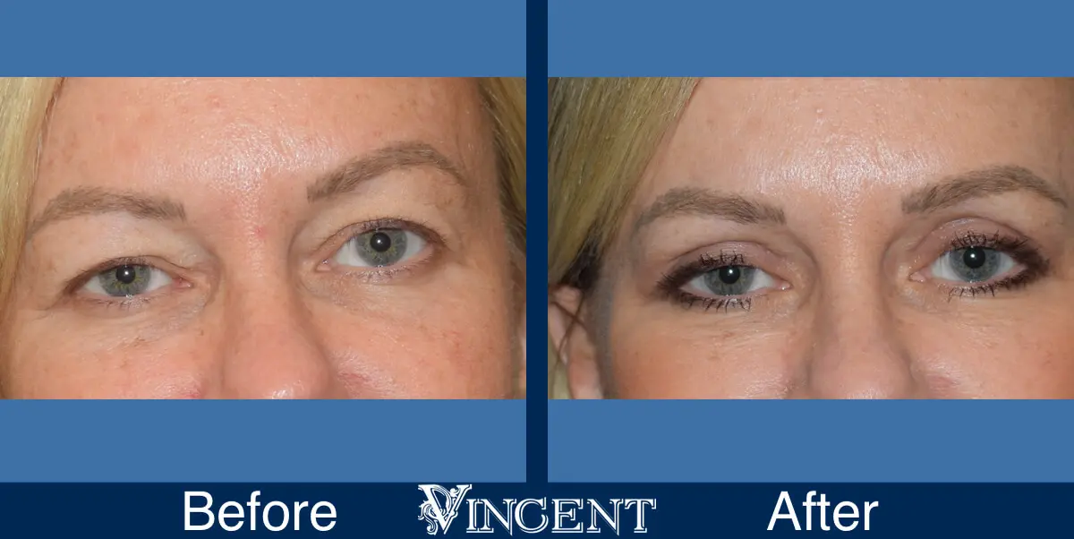 blepharoplasty-utah-C-front