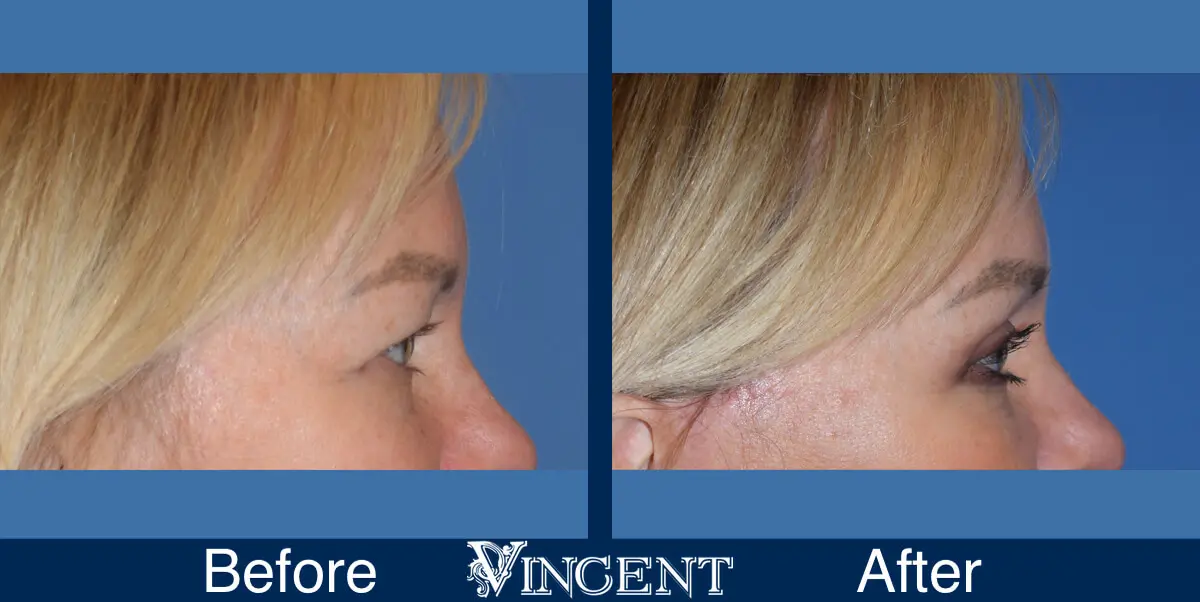 blepharoplasty-utah-C-side