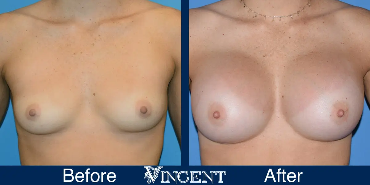 breast-augmentation-before-and-after-photo-front-1464