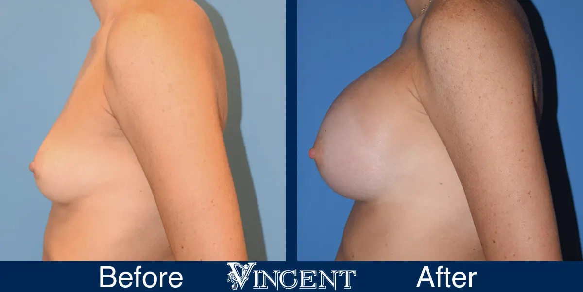 breast-augmentation-before-and-after-photo-side-1464