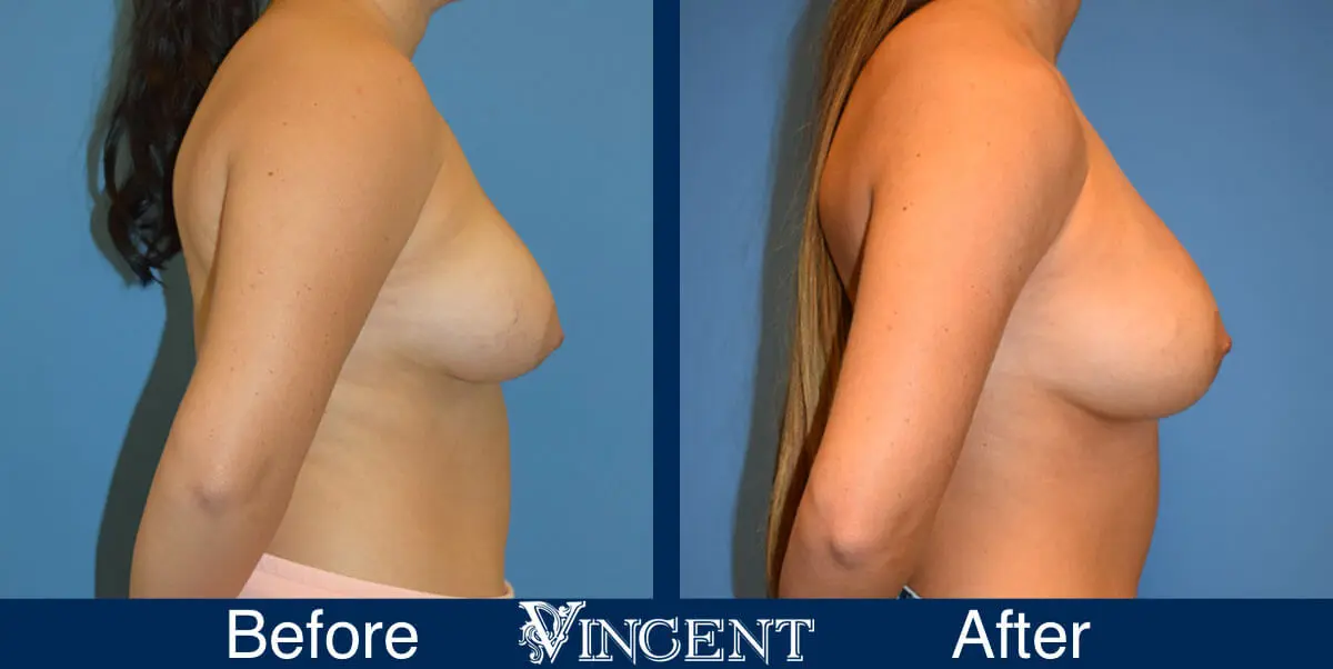 breast-augmentation-before-and-after-salt-lake-city-utah-vincent-surgical-arts-1652-side