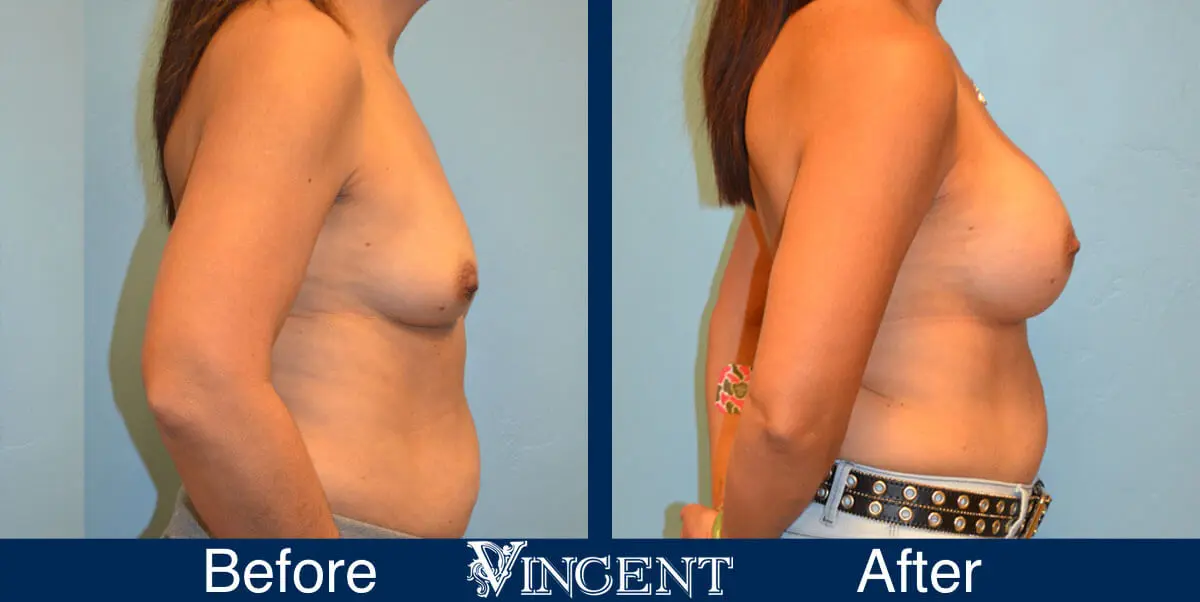 breast-augmentation-before-and-after-salt-lake-city-utah-vincent-surgical-arts-2171-side