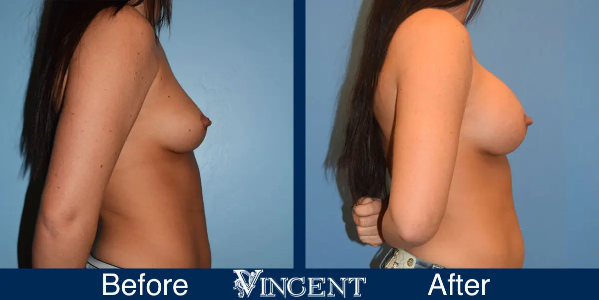 breast-augmentation-before-and-after-salt-lake-city-utah-vincent-surgical-arts-3169-side