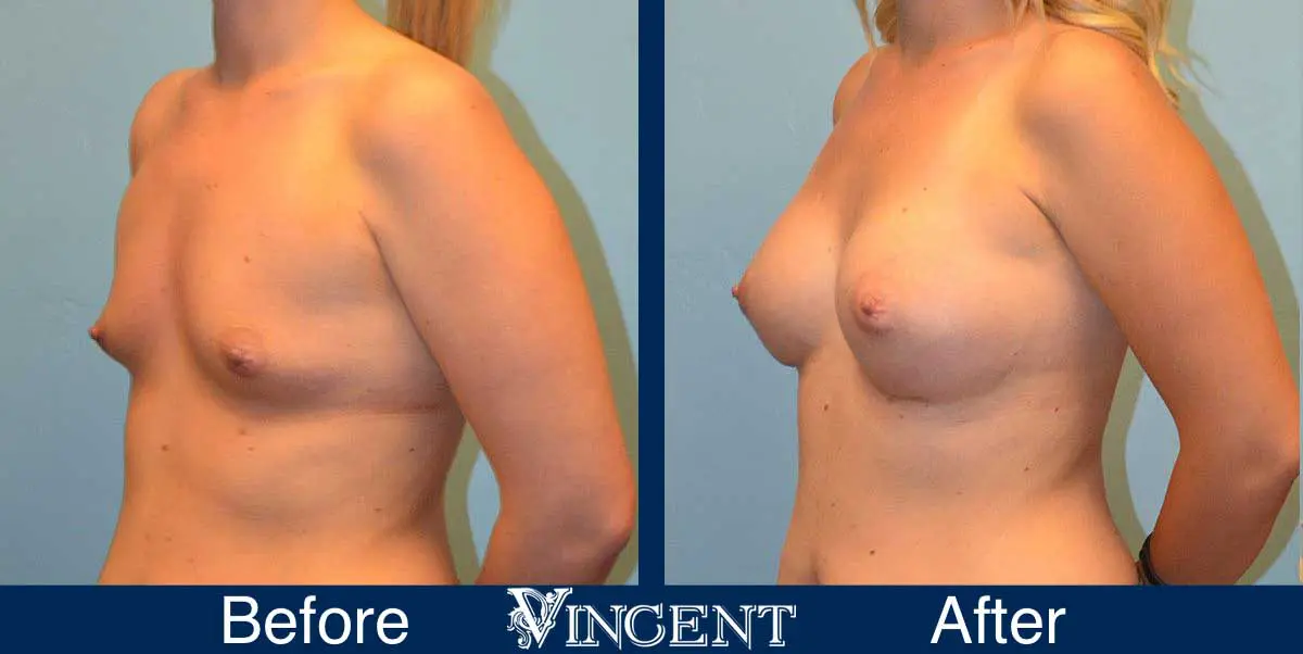 breast-augmentation-before-and-after-salt-lake-city-utah-vincent-surgical-arts-9008-Front-Left