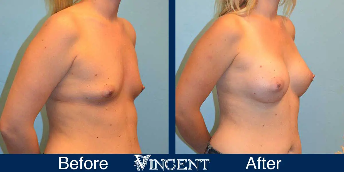 breast-augmentation-before-and-after-salt-lake-city-utah-vincent-surgical-arts-9008-Front-Right