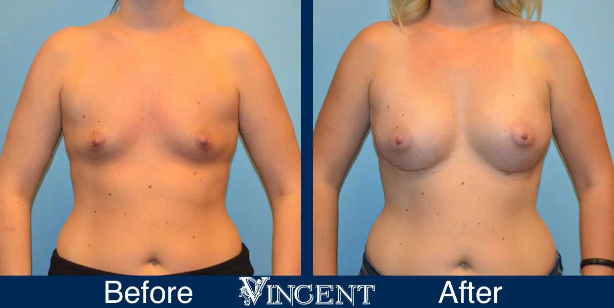 breast-augmentation-before-and-after-salt-lake-city-utah-vincent-surgical-arts-9008-Front