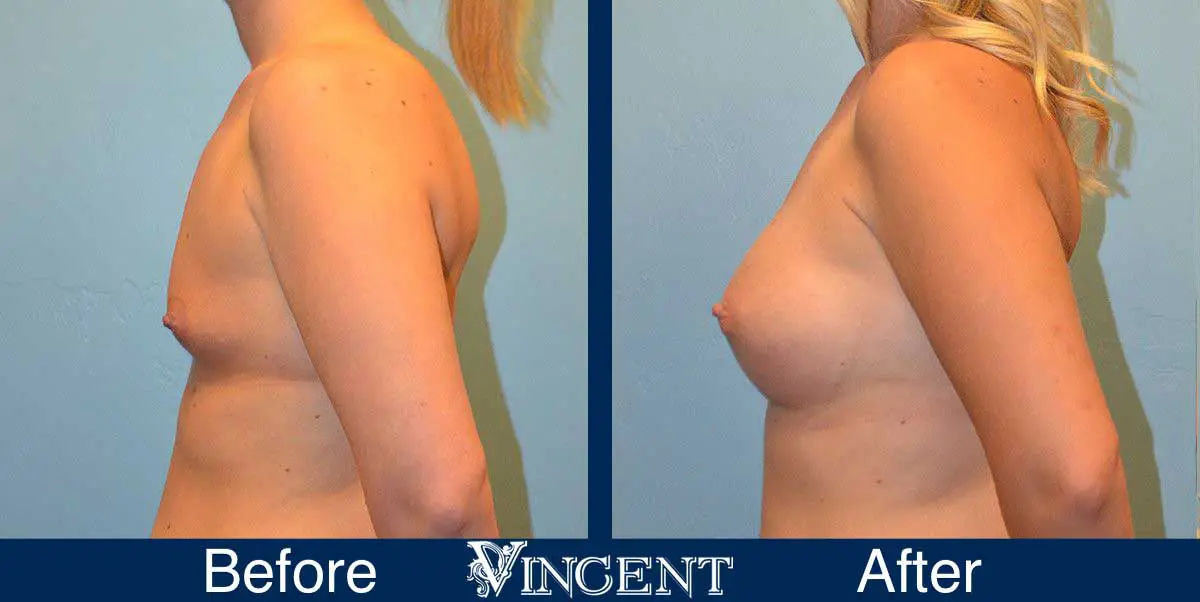 breast-augmentation-before-and-after-salt-lake-city-utah-vincent-surgical-arts-9008-Left