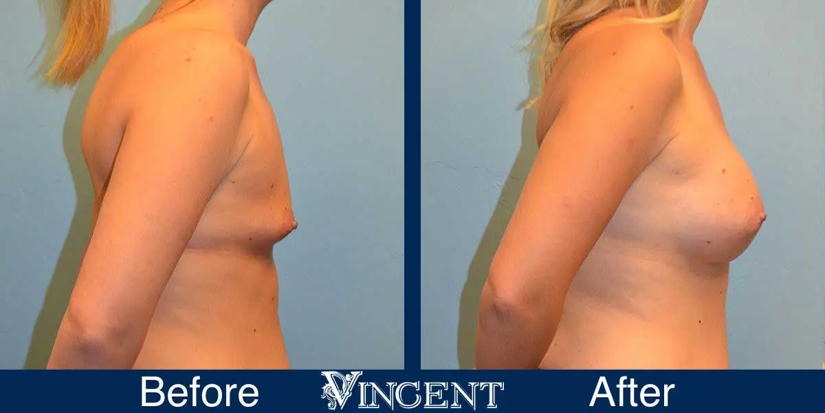 breast-augmentation-before-and-after-salt-lake-city-utah-vincent-surgical-arts-9008-Right