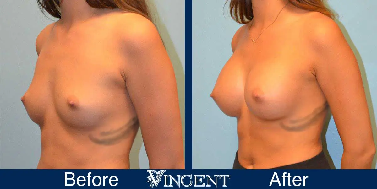 breast-augmentation-before-and-after-salt-lake-city-utah-vincent-surgical-arts-9009-Front-Left