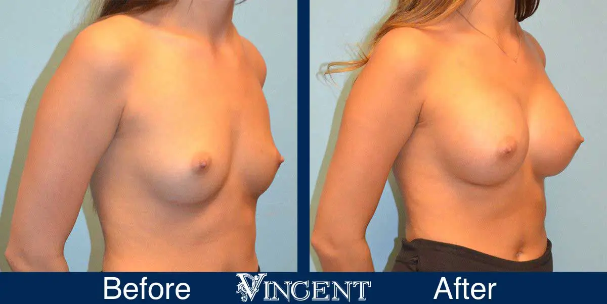 breast-augmentation-before-and-after-salt-lake-city-utah-vincent-surgical-arts-9009-Front-Right