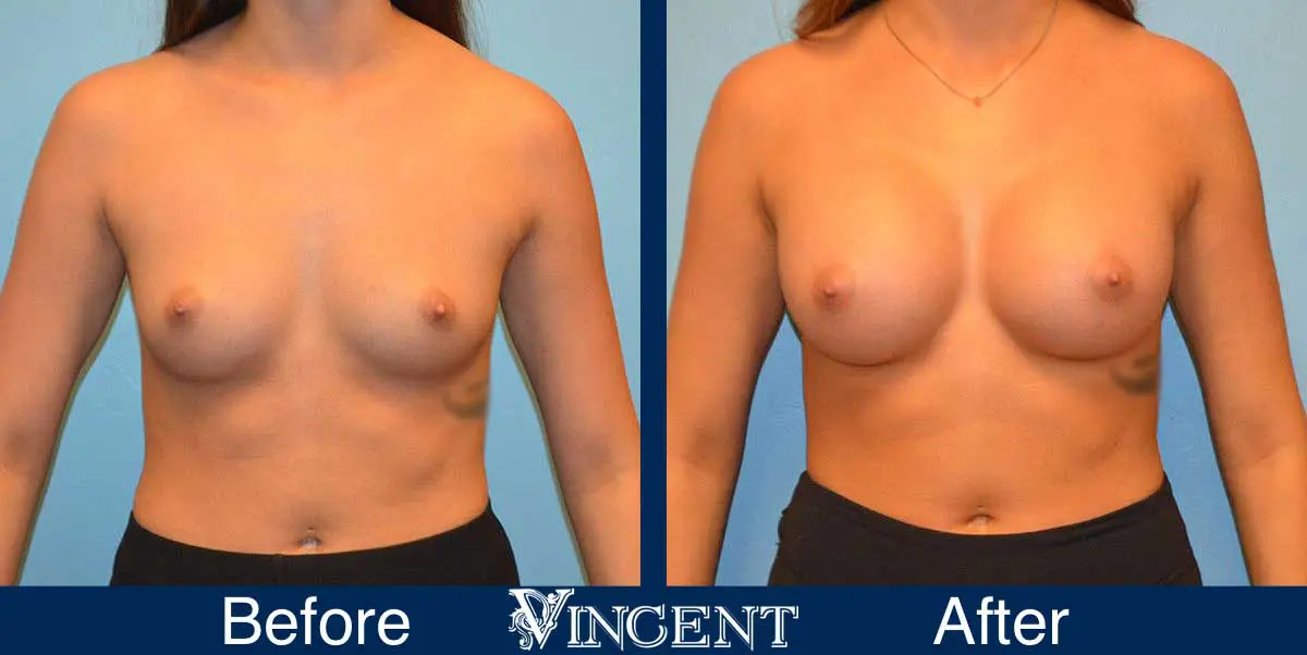 breast-augmentation-before-and-after-salt-lake-city-utah-vincent-surgical-arts-9009-Front