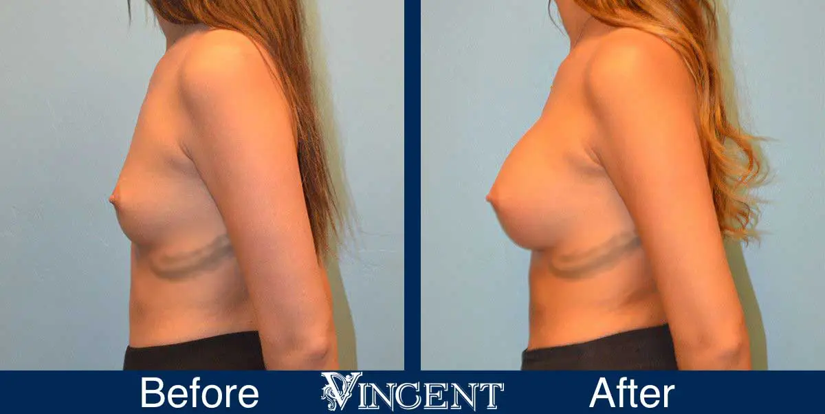 breast-augmentation-before-and-after-salt-lake-city-utah-vincent-surgical-arts-9009-Left