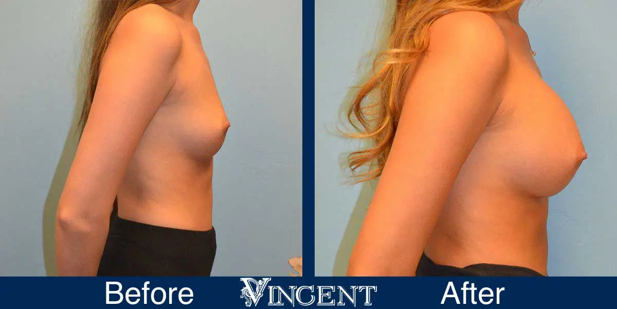 breast-augmentation-before-and-after-salt-lake-city-utah-vincent-surgical-arts-9009-Right