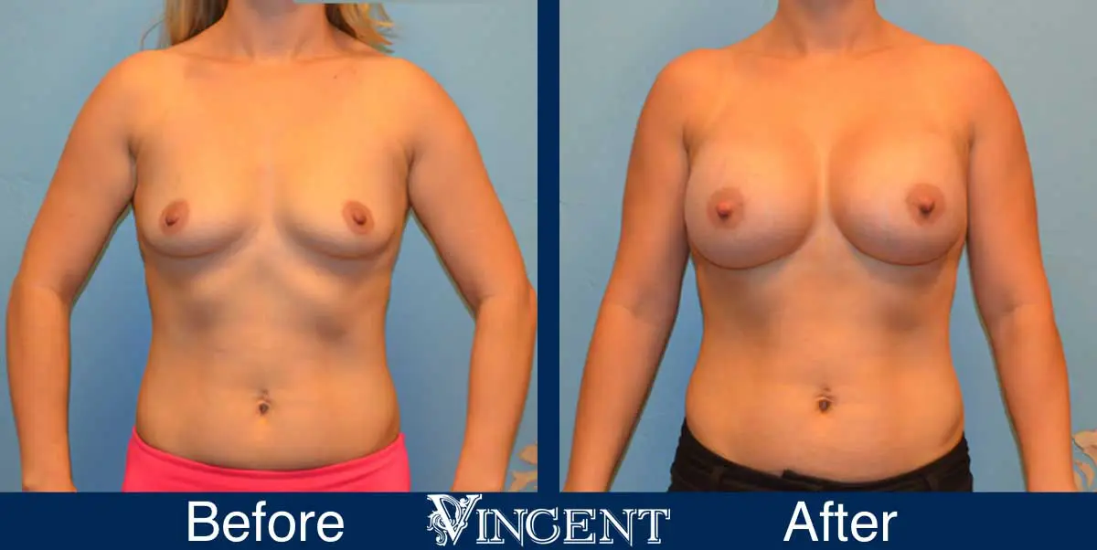 breast-augmentation-before-and-after-salt-lake-city-utah-vincent-surgical-arts-9011-front