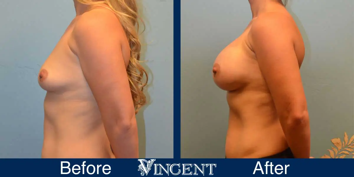 breast-augmentation-before-and-after-salt-lake-city-utah-vincent-surgical-arts-9011-left