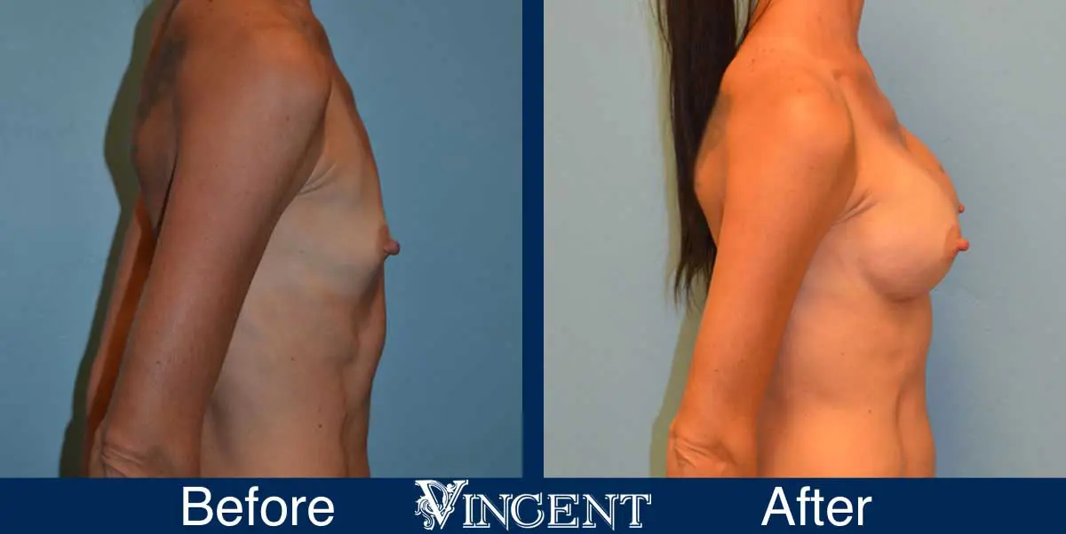 breast-augmentation-before-and-after-salt-lake-city-utah-vincent-surgical-arts-9012-right-side