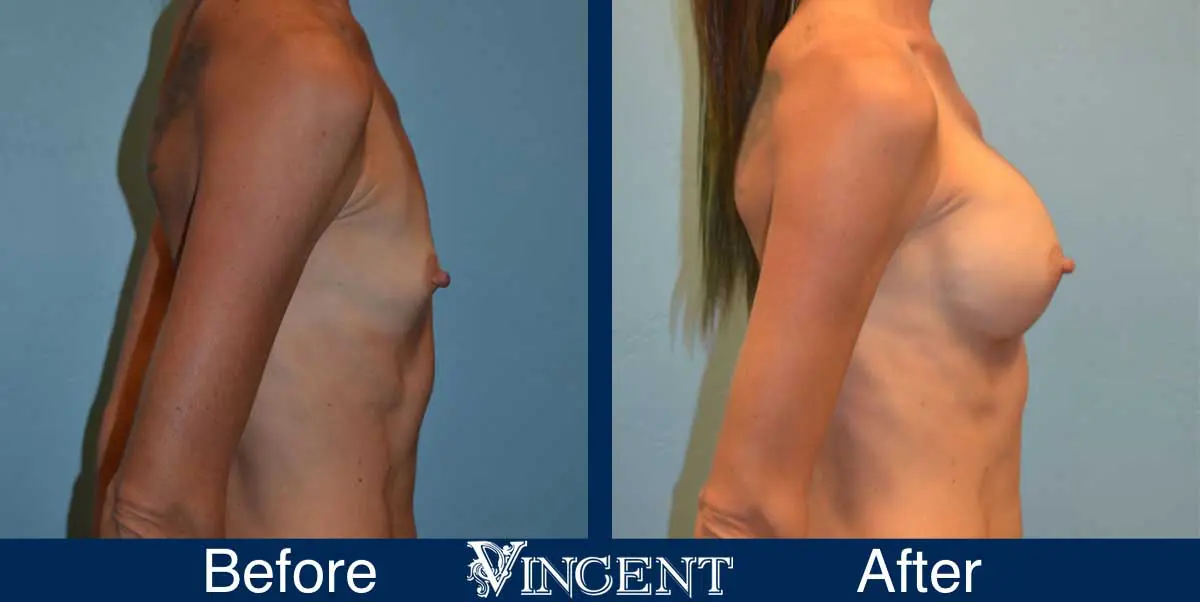 breast-augmentation-before-and-after-salt-lake-city-utah-vincent-surgical-arts-9012-right-side2