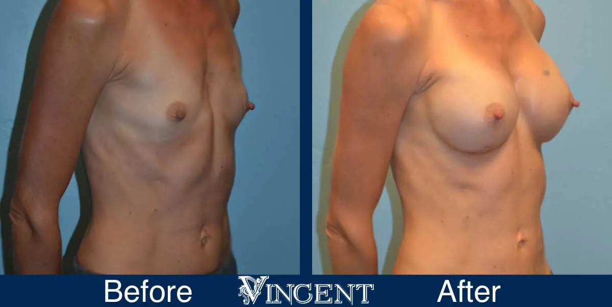 breast-augmentation-before-and-after-salt-lake-city-utah-vincent-surgical-arts-9012-right
