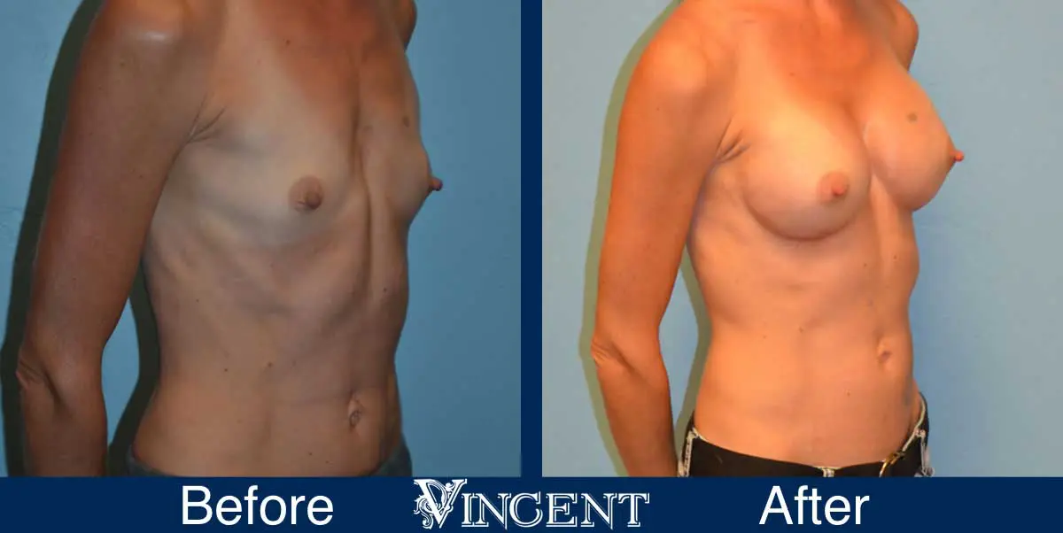 breast-augmentation-before-and-after-salt-lake-city-utah-vincent-surgical-arts-9012-right2