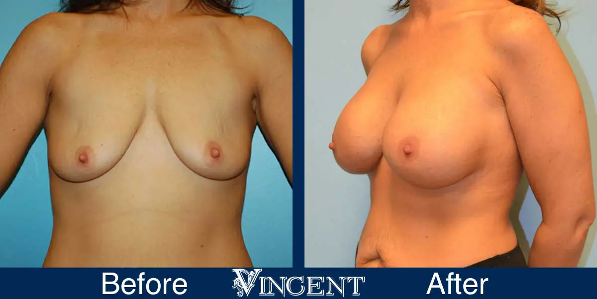 breast-augmentation-before-and-after-salt-lake-city-utah-vincent-surgical-arts-9013-front