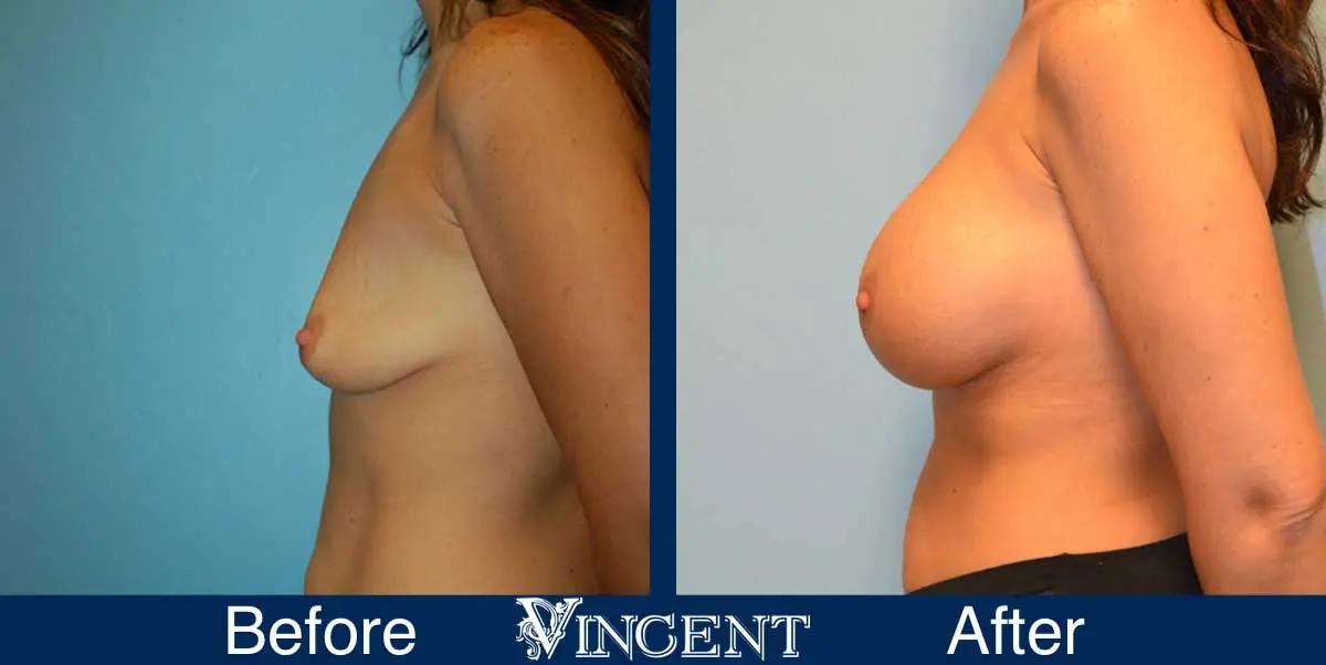breast-augmentation-before-and-after-salt-lake-city-utah-vincent-surgical-arts-9013-left-side
