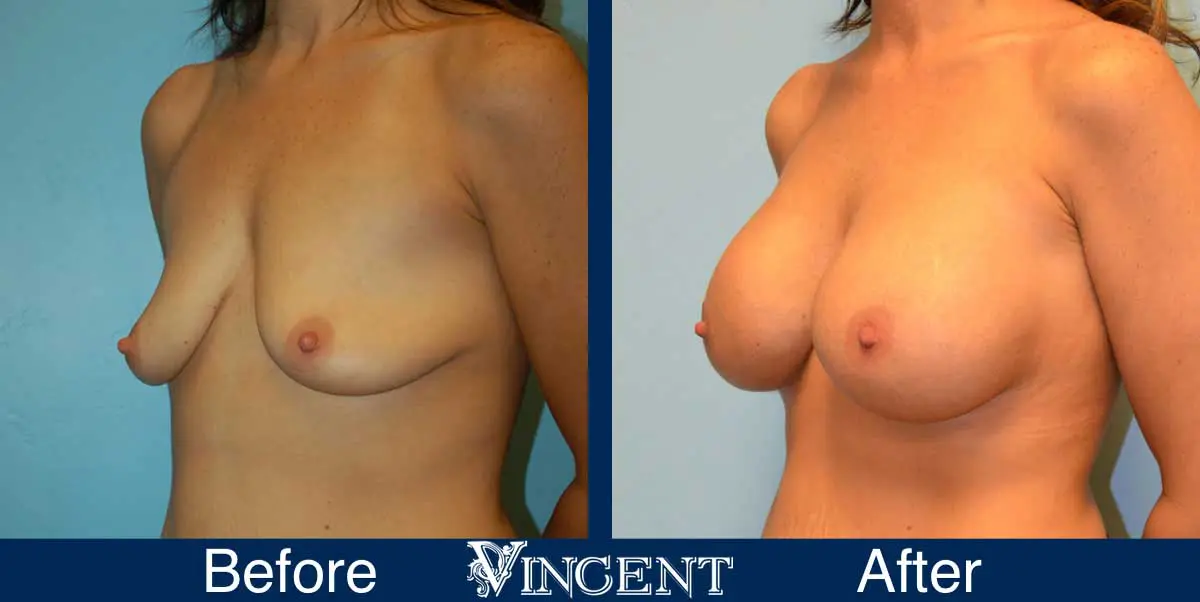 breast-augmentation-before-and-after-salt-lake-city-utah-vincent-surgical-arts-9013-left