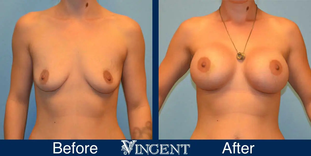 breast-augmentation-before-and-after-salt-lake-city-utah-vincent-surgical-arts-9014-front