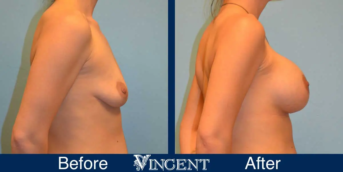 breast-augmentation-before-and-after-salt-lake-city-utah-vincent-surgical-arts-9014-right-side