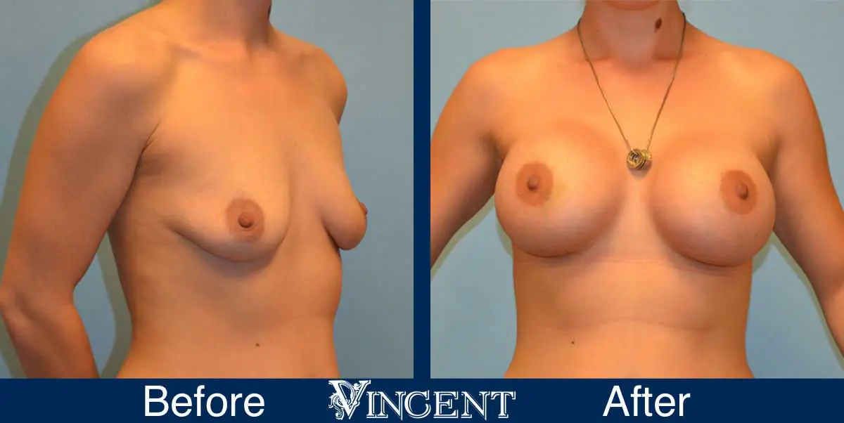breast-augmentation-before-and-after-salt-lake-city-utah-vincent-surgical-arts-9014-right